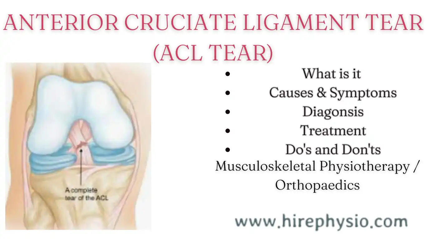 ANTERIOR CRUCIATE LIGAMENT TEAR (ACL TEAR) by Hirephysio.com