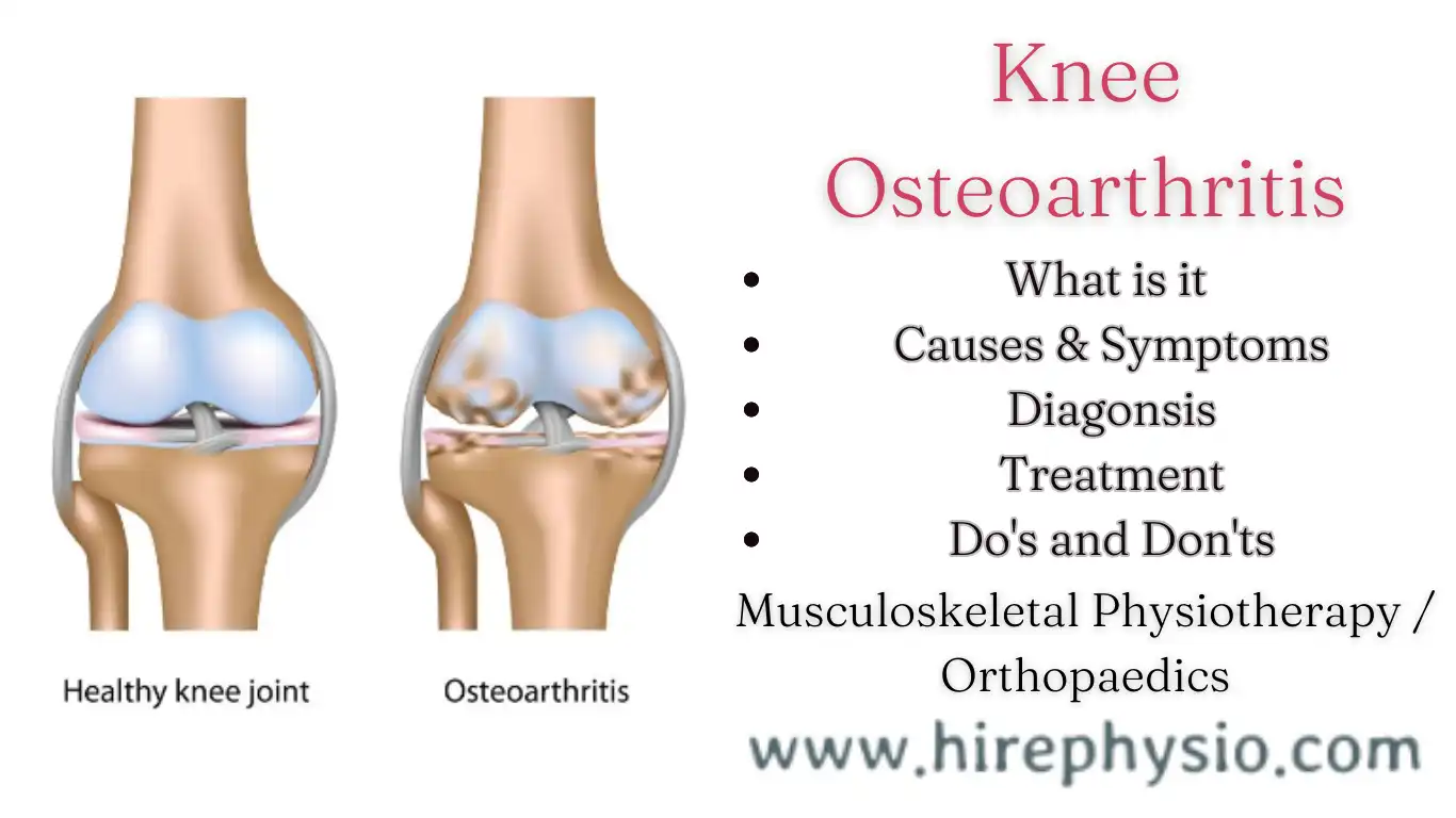 Effective Treatment Options for Knee Osteoarthritis at Hirephysio.com