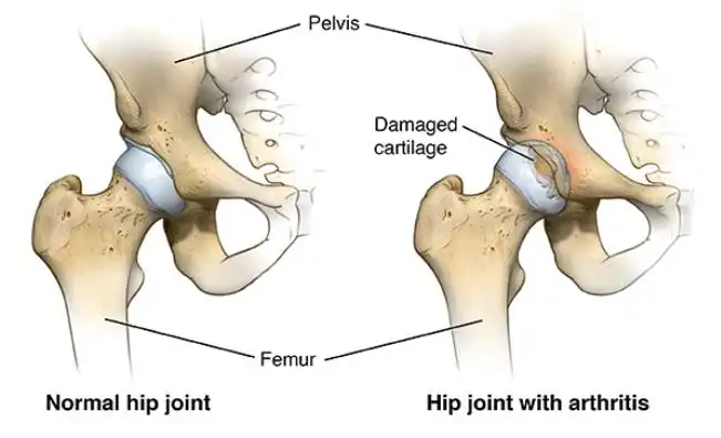 Hip joint with Arthritis