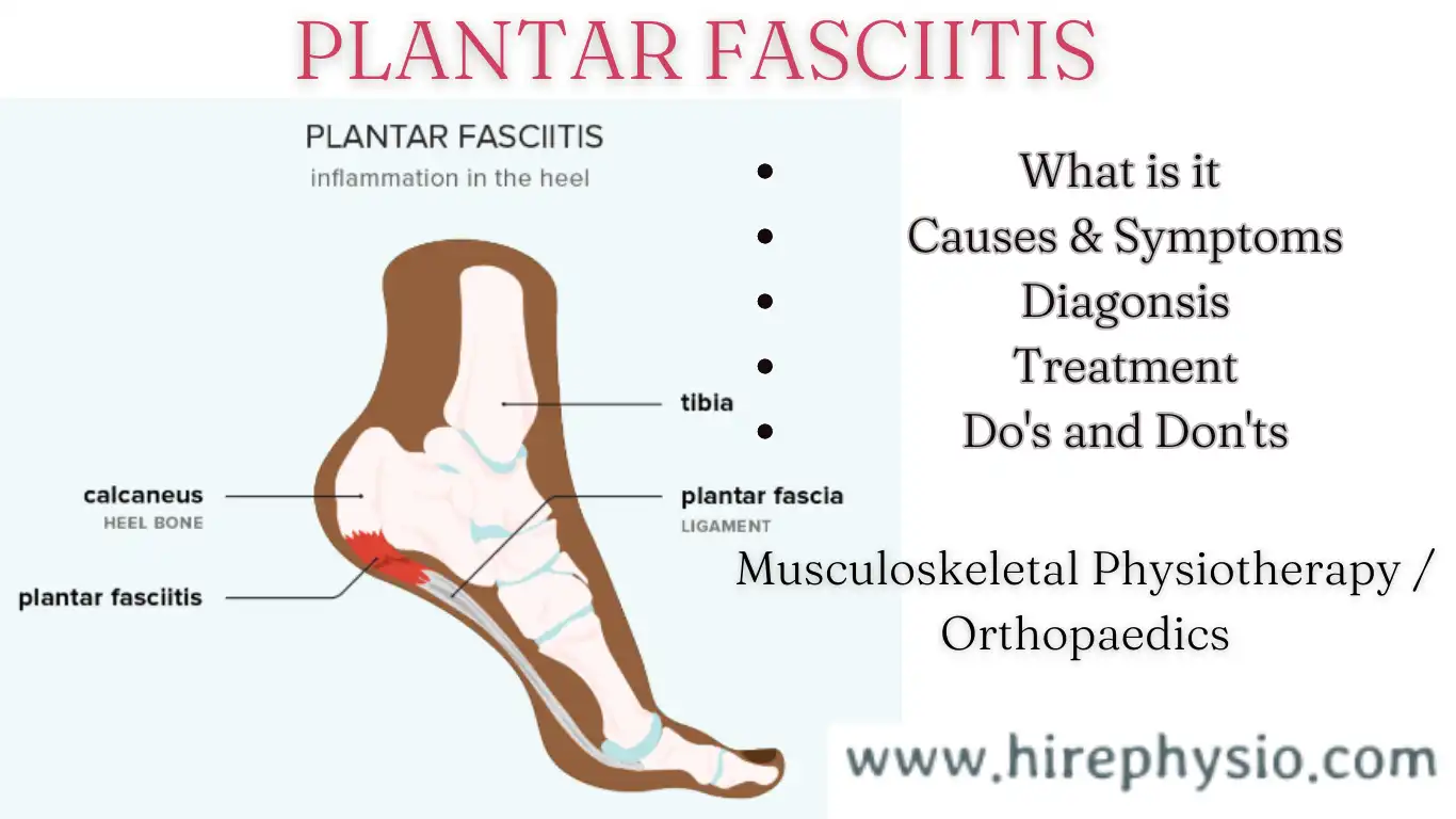 Get Quick Relief Now: 3 Way - Effective Treatment Options for Plantar Fasciitis at HirePhysio.com