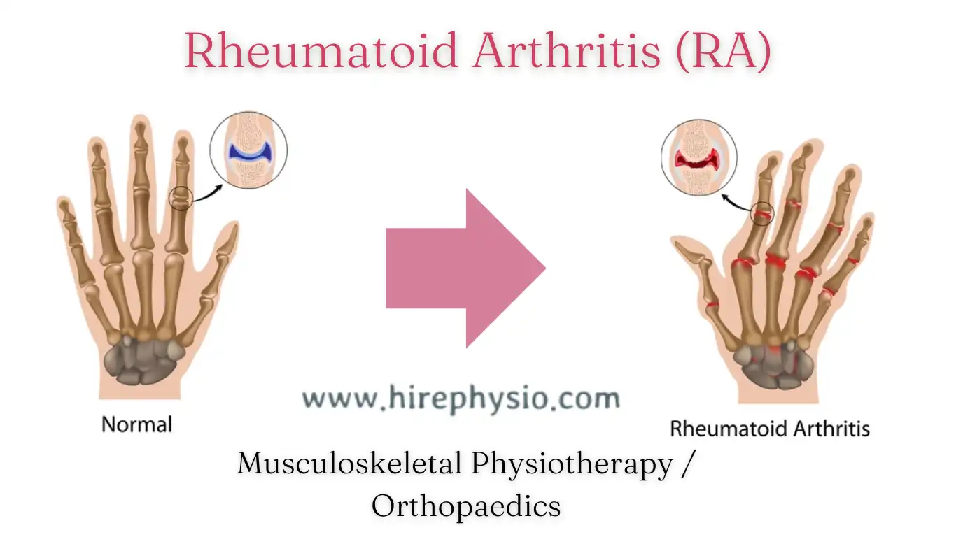 Difference between Normal hand and Rheumatoid Arthritis (RA) affected hand